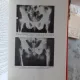 DIAGNOSTICUL CANCERULUI DE PROSTATA DE E. PROCA , 1977