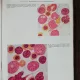 DIAGNOSTICUL HEMATOLOGIC VOL. I /VOL II- R.TANASESCU